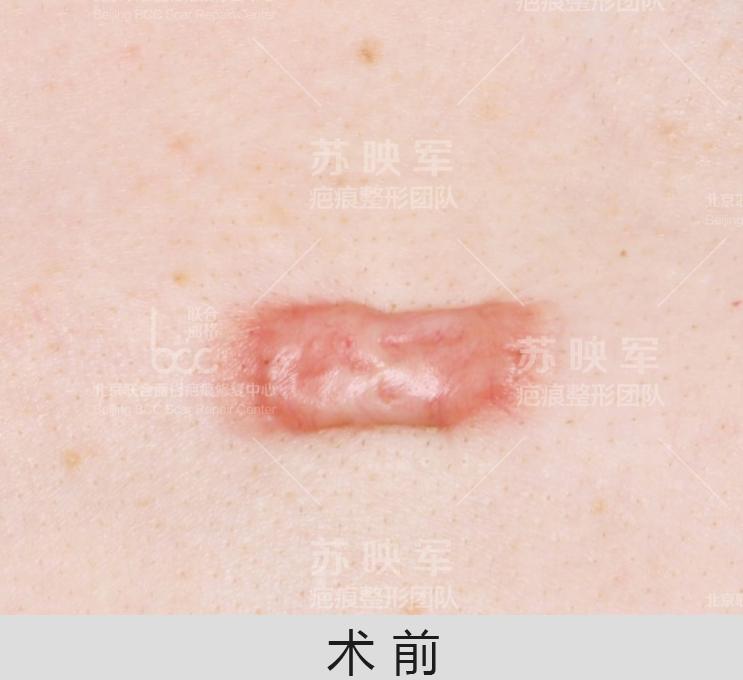 疝气最新疗法揭秘，小巷深处的治愈秘密探索